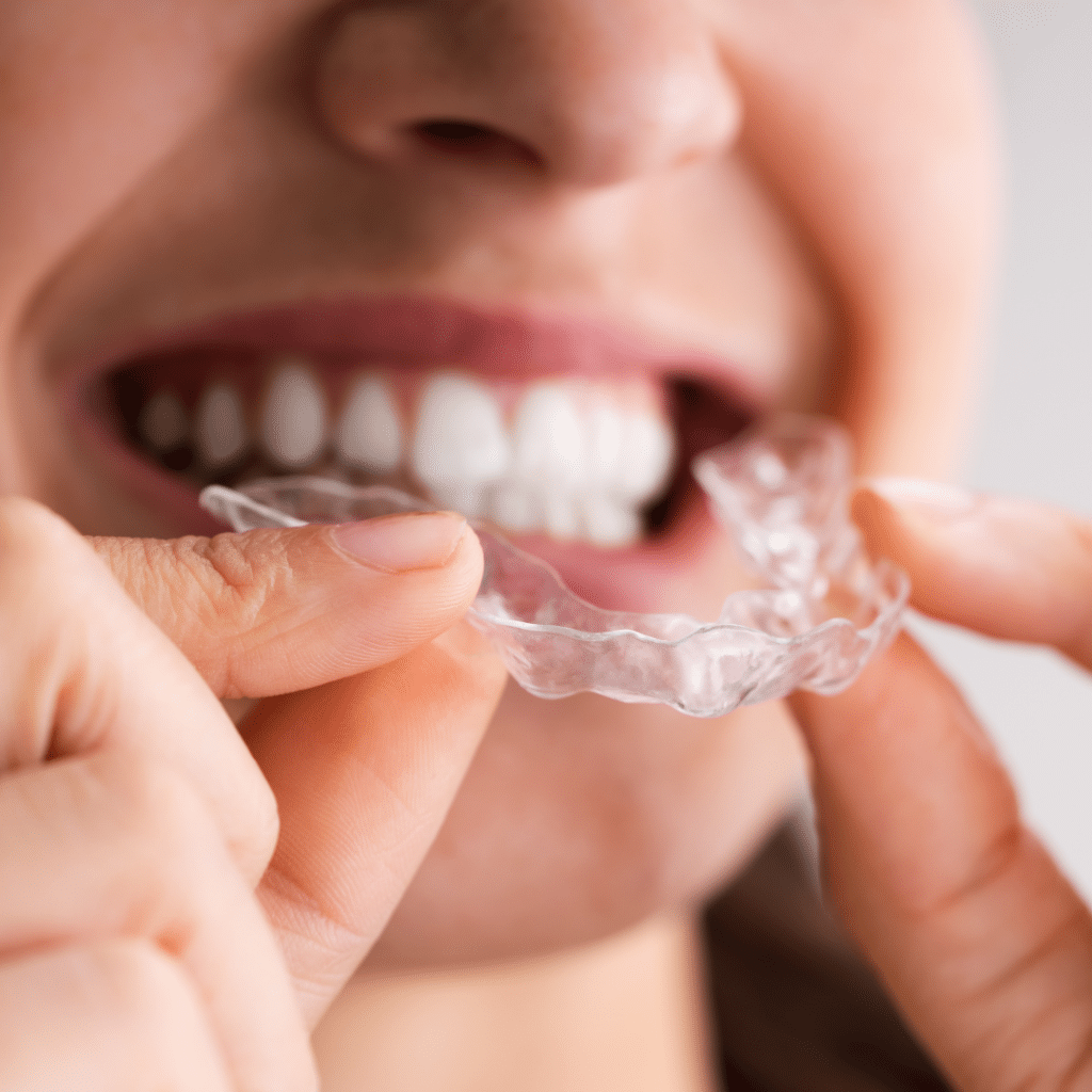 Clear Aligners Quad City Orthodontics in Bettendorf, IA, Rock Island and Geneseo, IL