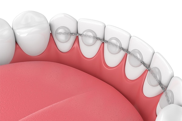 Fixed Retainers Quad City Orthodontics in Bettendorf, IA, Rock Island and Geneseo, IL